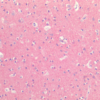 Immunohistochemistry analysis using Rabbit Anti-Tau Polyclonal Antibody (57011). Tissue: Brain Cortex. Species: Human. Fixation: Formalin fixed paraffin-embedded. Primary Antibody: Rabbit Anti-Tau Polyclonal Antibody (57011).